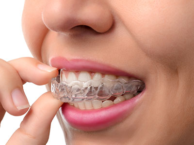 The image shows a person with a clear aligner, brushing their teeth while holding the aligner in their mouth.