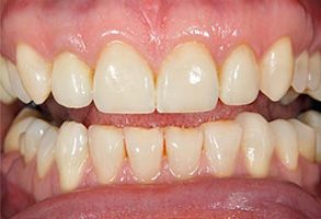 The image shows a close-up of a person s teeth, which appear to be in the process of being straightened with braces.