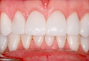 The image shows a close-up of a person s teeth and gums, with the teeth appearing white and clean.