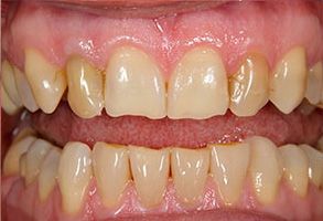 An image of a person s teeth with yellowing and staining, showcasing a dental condition or treatment.