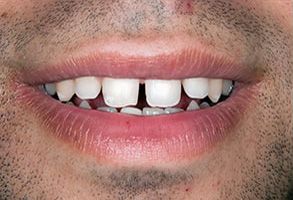 The image shows a close-up of a person s mouth with teeth, displaying a wide smile.